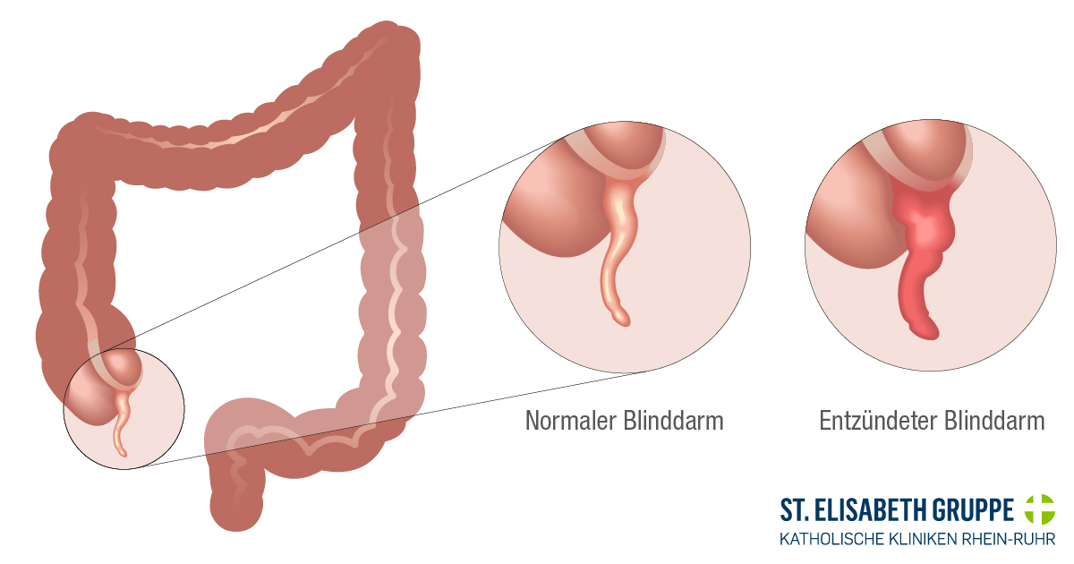 Bei einer Blinddarmentzündung (Appendizitis) ist der sogenannte Wurmfortsatz (Appendix vermiformis) am Ende des Blinddarms, der sich im Unterbauch befindet, entzündet. 