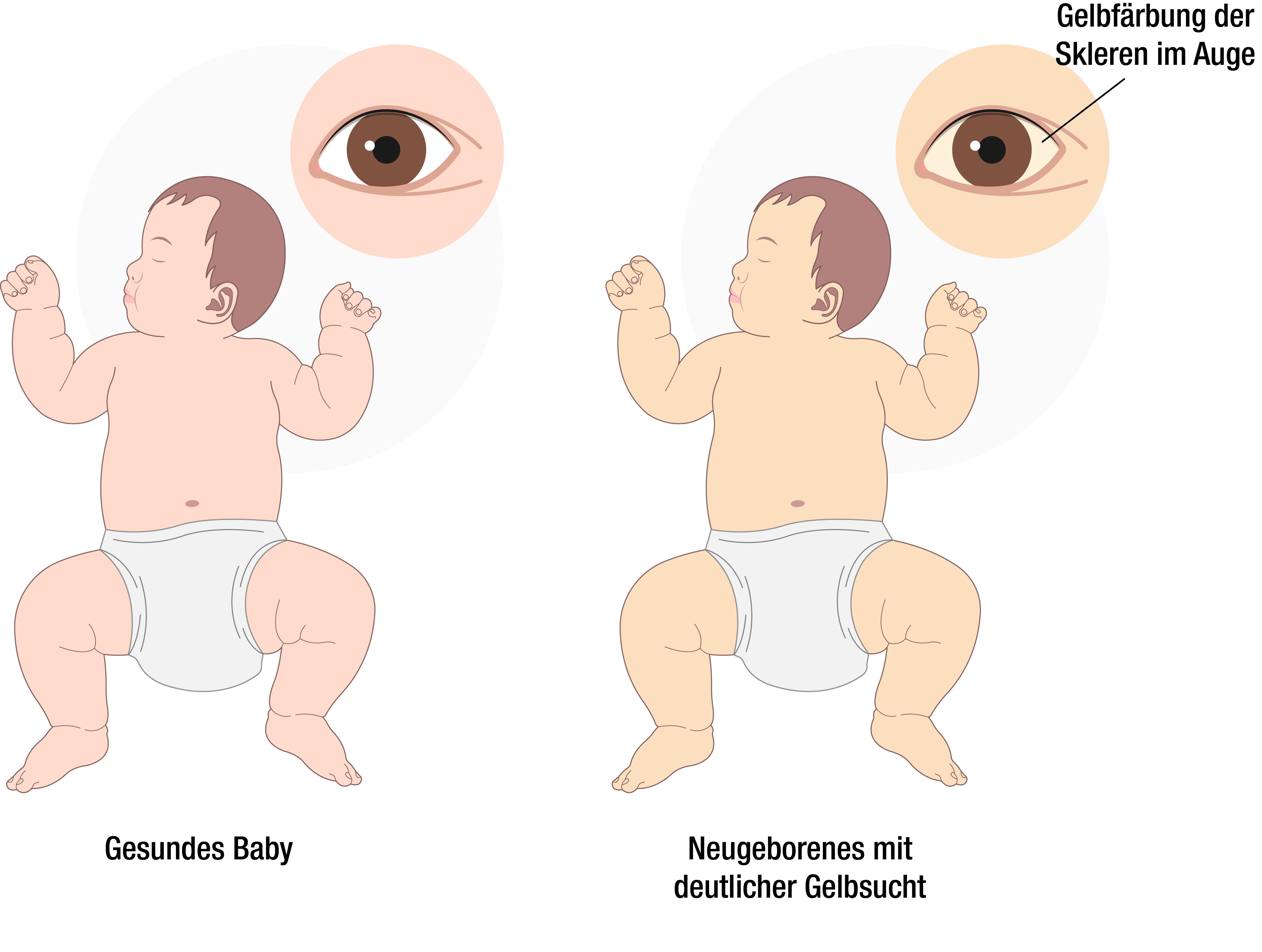 Eine Grafik zeigt zwei Babys. Sie unterscheiden sich in ihrer Farbe. Ein Baby sieht normal aus, das andere hat überdurchschnittlich gelbe Haut und Augen – ein Zeichen für Neugeborenengelbsucht.